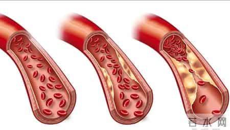 间隔一天吃他汀，降脂效果更好？医生提议：服用他汀，谨记这5点