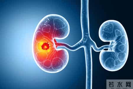 人有没有肾病，看喝水就知？医生：有肾病的人，喝水多会有5异常