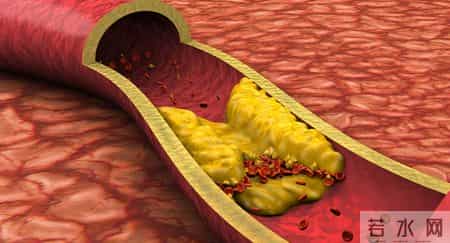 体检报告里这一项异常，竟是脑梗信号？9成人都不重视，后悔太晚