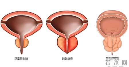 前列腺增生患者一旦活过71岁，大多出现如下症状，看看你占几个？