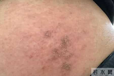 湿疹拖太久可能暗藏隐患，医生提醒：皮肤若出现这5种异常要警惕