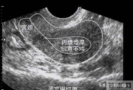 查出子宫内膜厚！调整生活方式真的有用吗？医生给你唠明白