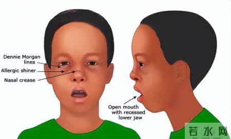 闭口贴成坑娃重灾区，家长盲目跟风，娃变丑还藏缺氧隐患