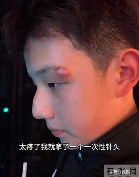 关凌13岁儿子长痘，妈妈随手一挑惹大祸，最后竟要动刀缝针