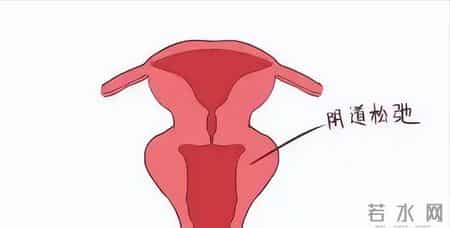 女性巨阴症可以生育吗？医生：主要看3种情况，不妨了解一下