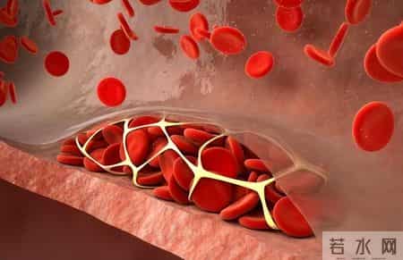 55岁男子冠脉狭窄85%，2年后却完全消失，他的3个方法，值得借鉴