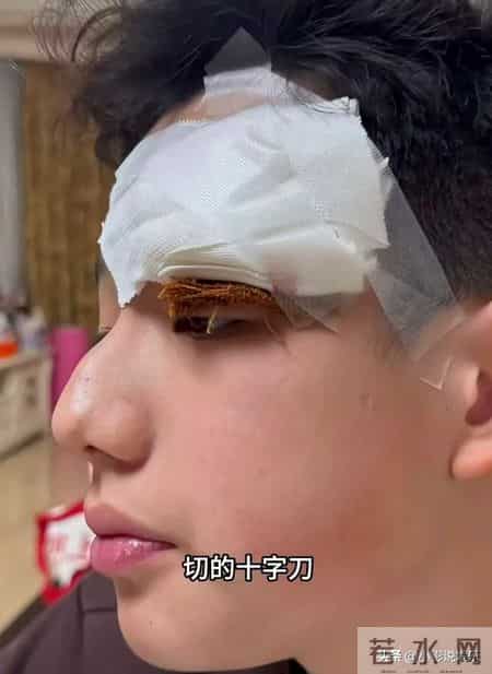 火疖子被误认青春痘 关凌粗心失误 孩子疤痕能淡化吗