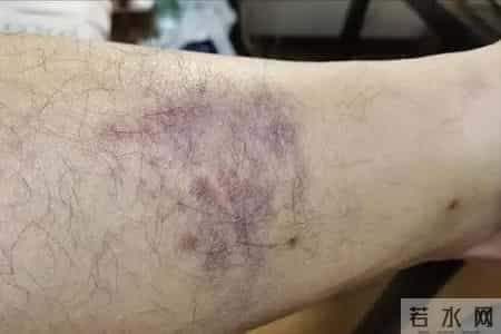 一旦腿部出现5个讯号，或说明血管已经开始堵塞，留意别不当回事