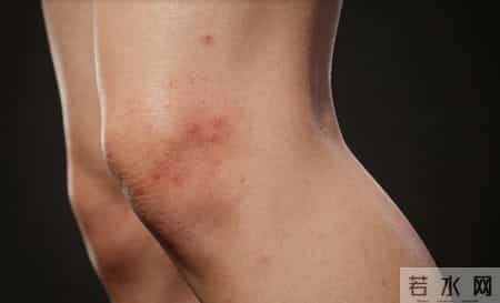 为何 HPV 相关疣类总反复？多数人忽略的1个关键，比激光冷冻更管用