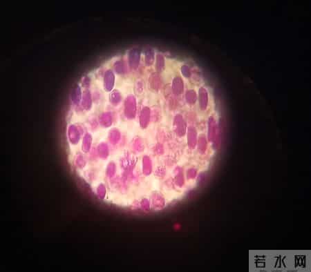 人不会平白无故患带状疱疹？医生：患带状疱疹，或有5个隐藏原因