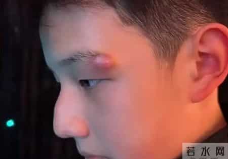 关凌为子挤痘缝4针！真心劝各位家长，别再瞎动手了