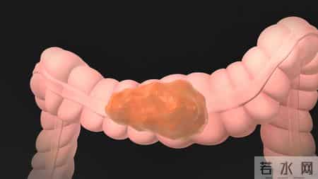 为什么很多人不愿做肠镜？医生：做一次肠镜，或能保你3年没问题