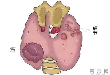 中医提醒：甲状腺有“结节”，可能和这2个坏习惯有关，及时改掉