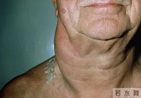 甲状腺癌手术很成功，病人却活不长？医生：很多人忽视术后这几事