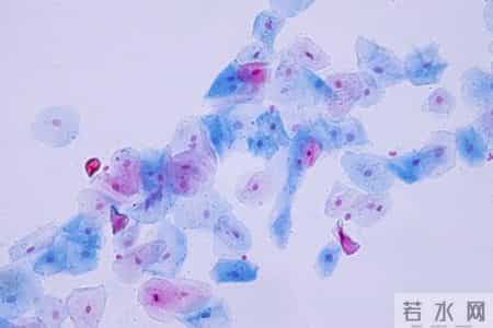 体检报告中这个指标升高，或是肺癌早期信号，很多人却没当回事