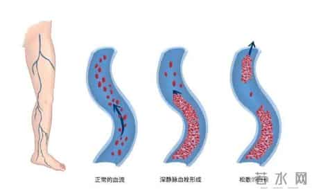 55岁男子冠脉狭窄85%，2年后却完全消失，他的3个方法，值得借鉴