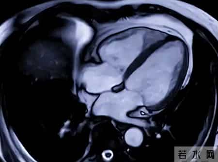总是胸痛、胸闷、心慌，却又检查不出问题？可能是心脏这里堵了！
