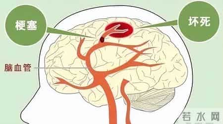 手指是脑梗“报警器”？脑梗前手指会出现这些症状，别大意！