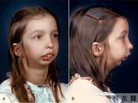 孩子睡觉总张嘴？腺样体面容真会变丑？医生拆解3大认知误区