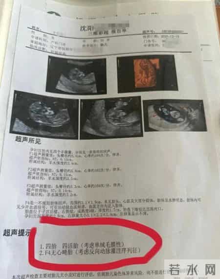孕妇两个月内从一胎变四胞胎，每次产检都多出一胎！医生：系同卵四胞胎，概率1300万至1500万分之一