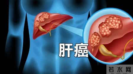 肝癌进展 5 个预警信号！忠告：出现一个就就医，别错过干预时机