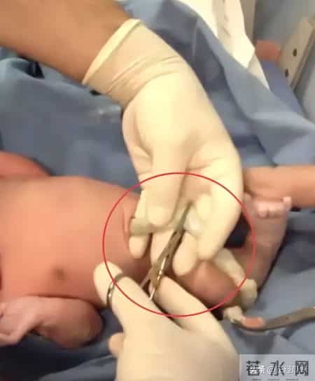 剪脐带剪到手指？1张新生儿“劫难图”，护士一句“乱动”想翻篇