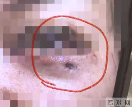 贵阳女子割眼袋遭灼伤，留疤五年未修复，整形医院突然撂挑子！面对记者质疑，经理扬言：还制约不了你们？