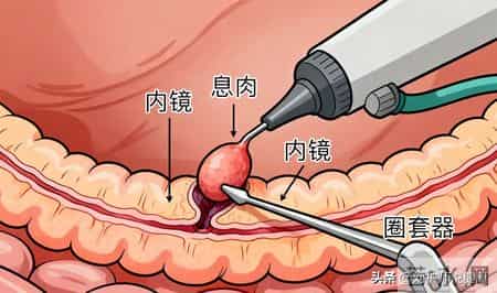 数名医生提醒：只要做过肠息肉切除手术，术后患者多关注这9点