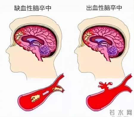 医生研究发现：低密度脂蛋白降得太低，心脏笑了，大脑可能哭了！