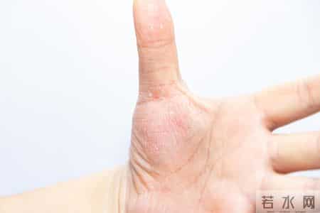 人不会平白无故患带状疱疹？医生：患带状疱疹，或有5个隐藏原因