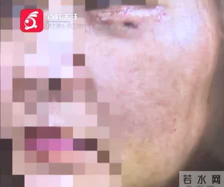 贵阳女子割眼袋遭灼伤，留疤五年未修复，整形医院突然撂挑子！面对记者质疑，经理扬言：还制约不了你们？