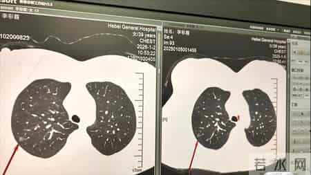 双肺多发结节最大7mm怎么办？微浸润阶段择期处理手术即治愈