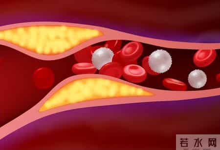 医生坦言：只要血脂报告里没有这几个词，血管健康就不用太担忧