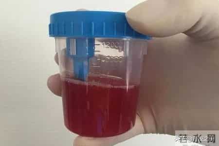 IgA肾病患者什么情况下需要免疫抑制治疗？