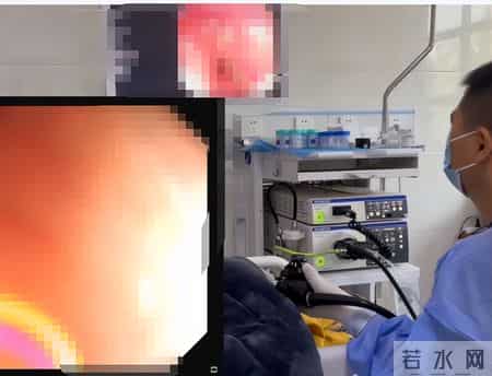 为啥很多人不愿意做肠镜？外国研究：做一次肠镜，或保十年安全？