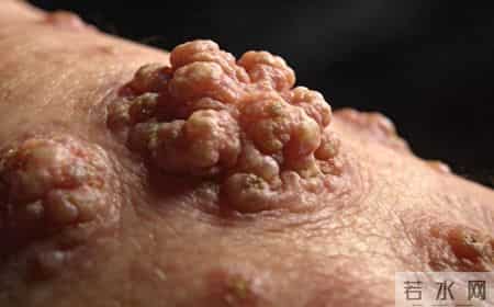 为何 HPV 相关疣类总反复？多数人忽略的1个关键，比激光冷冻更管用