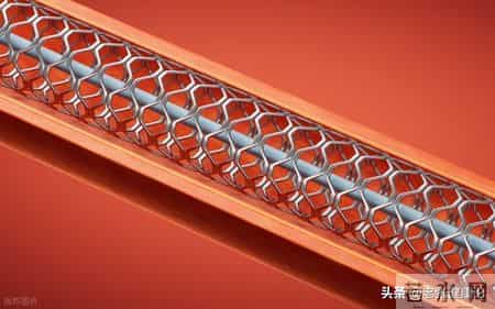 55岁大姐做完心脏支架，5年后复发走了，医生说：4点原因显而易见