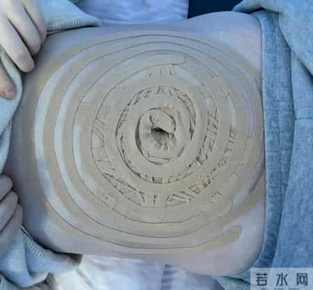 【特色治疗】“弹性铠甲”肌内效贴——对抗产后腰背痛、腹壁松弛、腹直肌分离的“小布贴”