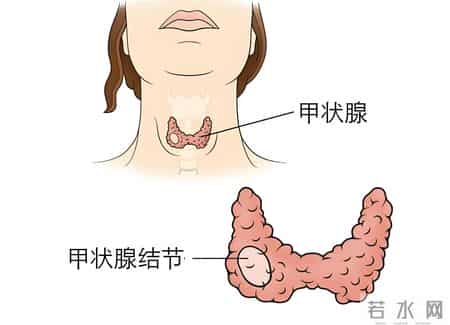 中医提醒：甲状腺有“结节”，可能和这2个坏习惯有关，及时改掉
