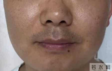 肝癌前最危险信号不是口干，而是这5个症状！