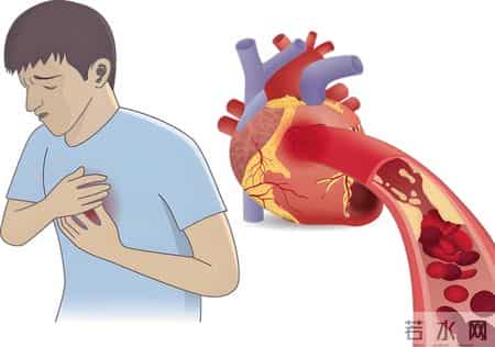 多名医生忠告：冠心病患者做完冠脉造影，务必重点看 4 项关键结果