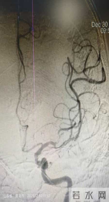 平度市第三医院神经内科力挽狂澜，成功抢救2名大脑中动脉急性闭塞患者