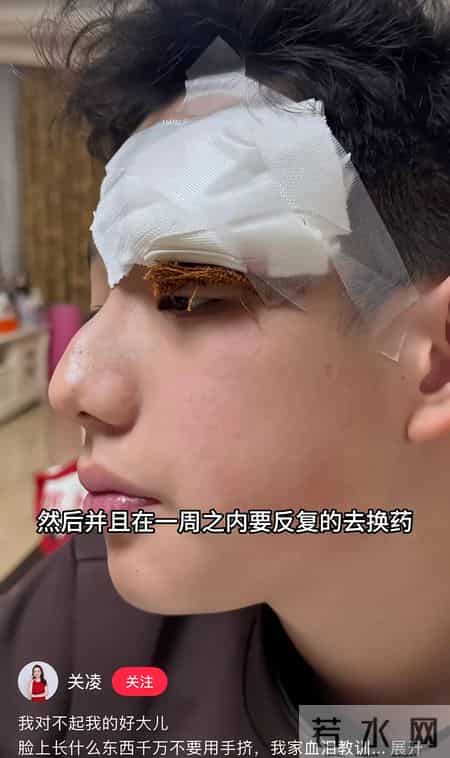 关凌为子挤痘缝4针！真心劝各位家长，别再瞎动手了