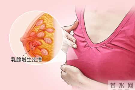 人为什么会得乳腺癌呢？医生直言：原来是这样来的，现在知道不晚