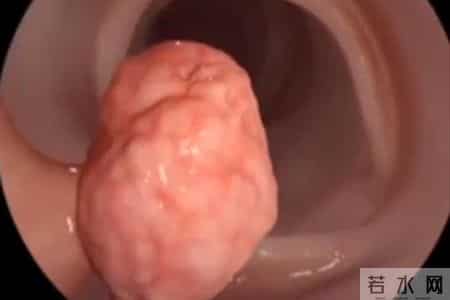 肠息肉不能吃红薯？医生反复提醒：想避免复发，3样食物得慎吃