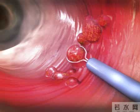 为什么很多人不愿做肠镜？医生：做一次肠镜，或能保你5年没问题