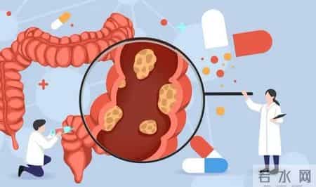 结直肠癌转移 5 危险信号！忠告：出现一个就就医，别耽误诊疗时机