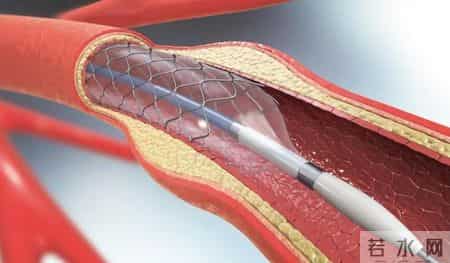 心梗后坚决不放支架会怎样？医生实话实说：两种结局，没有中间路