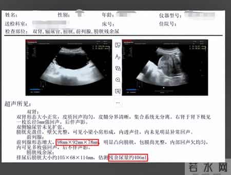 多名医生提醒：只要做过前列腺B超，中老年男性务必重视这2指标！
