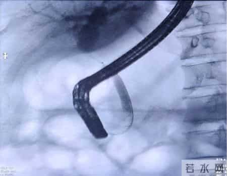 从精准诊断到微创根治！湘雅三医院成功救治复杂胆管癌患者